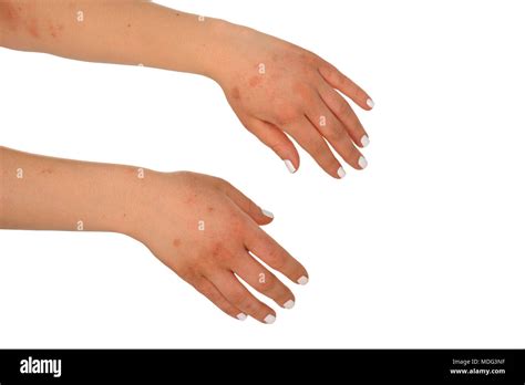 Skin Rash Eczema On Hands Hi Res Stock Photography And Images Alamy