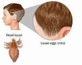 Home Remedies For Eggs Of Head Lice Images