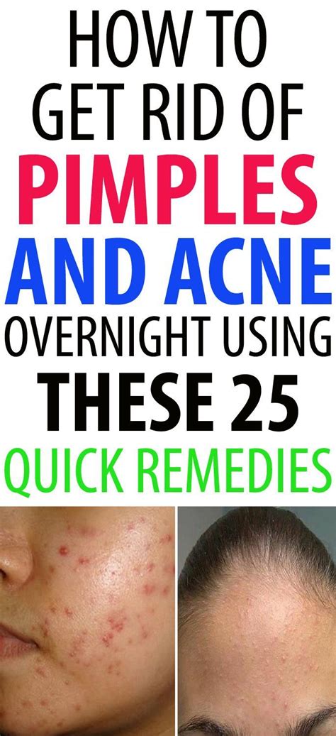 How To Get Rid Of Pimples Or Acne Overnight By Using Home Remedies