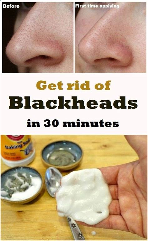 Remove Blackheads In 30 Minutes Blackhead Remedies