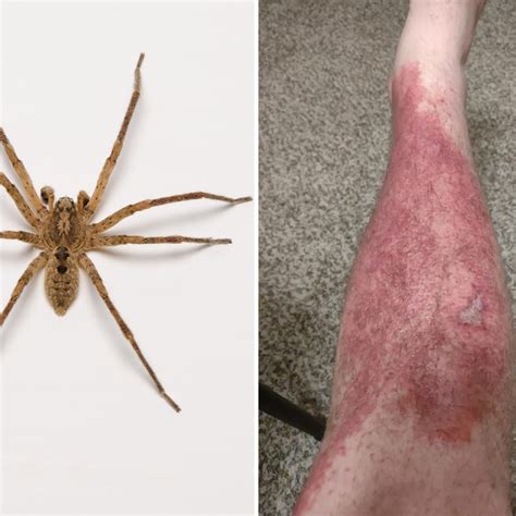 Brown Recluse Spider Bite Rash