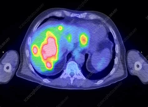 Secondary Cancer Ct And Pet Scans Stock Image M1340696 Science