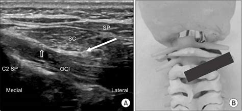 Ultrasound Guided Intervention In Cervical Spine