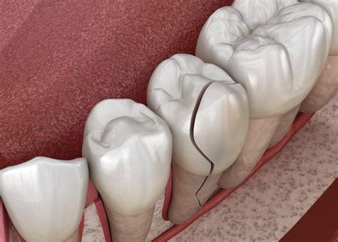 Treatment Options For A Broken Tooth Roosevelt Dental Center