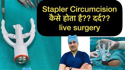 ZSR Circumcision Live Operation How Stapler Circumcision Is Done