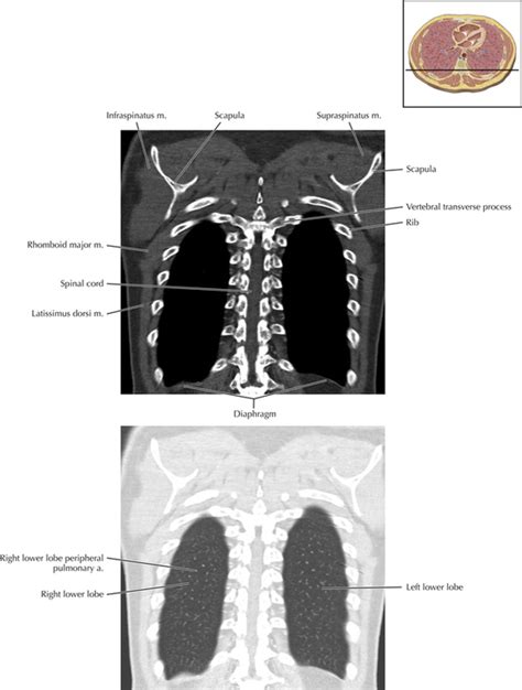 Thoracic Soft Tissue And Lung Radiology Key