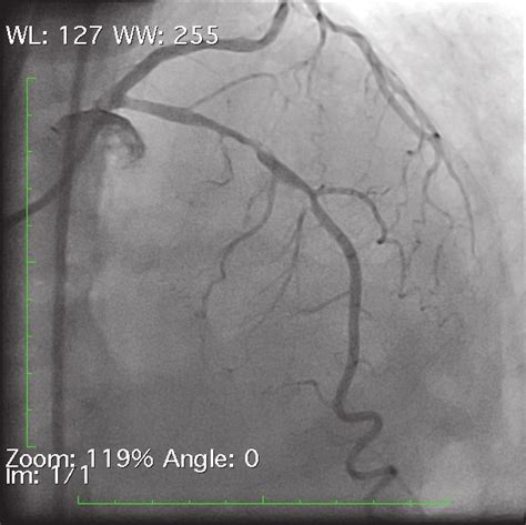 Right Anterior Oblique View Of Left Coronary System Showing 90
