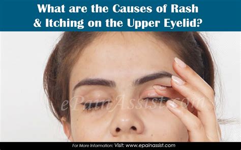Causes Of Rash And Itching On Upper Eyelid And Ways To Get Rid Of It