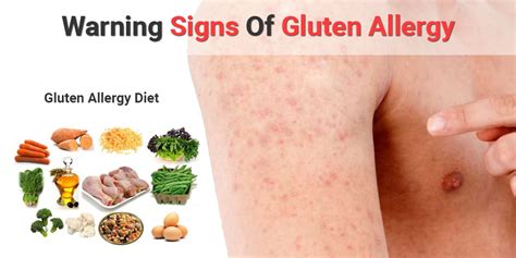 Gluten Allergy