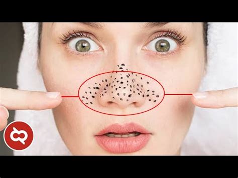 Entdecke rezepte, einrichtungsideen, stilinterpretationen und andere ideen zum ausprobieren. Cara Menghilangkan Komedo Untuk Anak Anak - Bisabo Channel