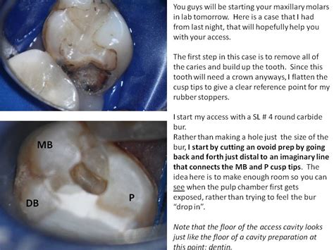 Tips For Molar Access Dana Point Endodontics Daniel J Boehne Dds