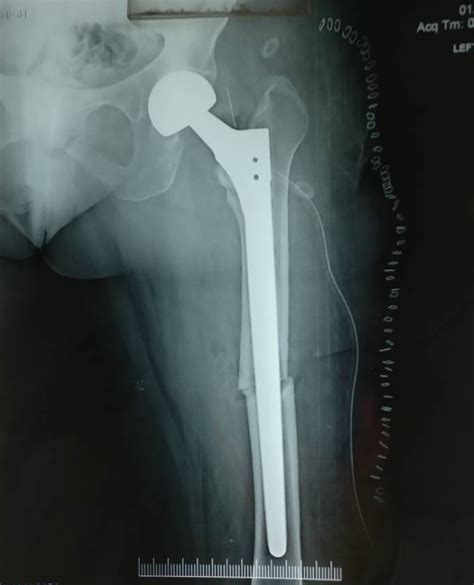 Successful Revision Partial Hip Replacement Surgery Patient From