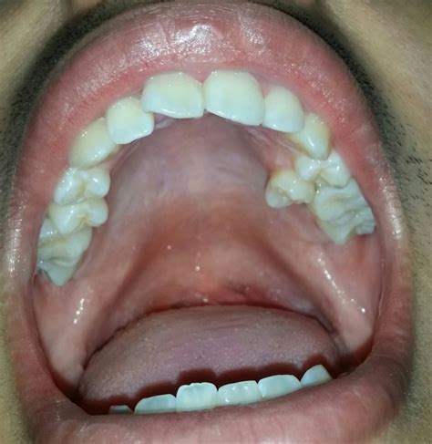 Normal Roof Of Mouth Color Introduction Check Your Mouth 2017 With
