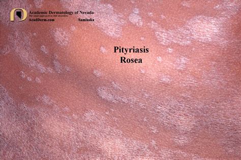 Pityriasis Rosea Pityriasis Rosea Dermatology Oasis Consult A Doctor