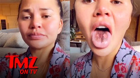Chrissy Teigens Tongue Is Peeling After Eating Too Much Sour Candy