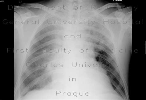 Radiology Case Atypical Pneumonia Pleural Effusion