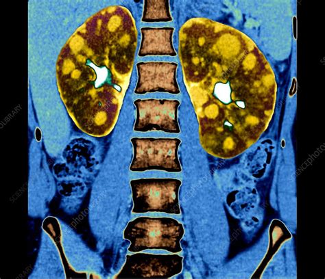 Polycystic Kidneys Ct Scan Stock Image C0525651 Science Photo