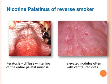 Tobacco Smoking And Oral Cancer