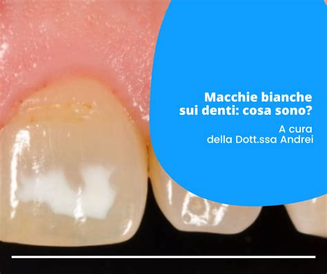 COSA SONO LE MACCHIE BIANCHE SUI DENTI Studio Dentistico Alessandrini