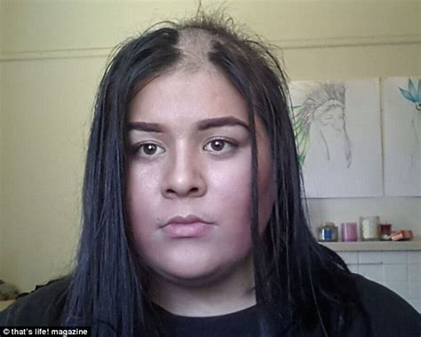 Meet Sydney S Tiarne Menzies Who Went Bald In Her Sleep Daily Mail Online
