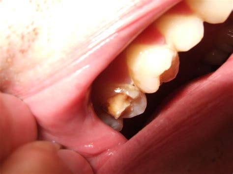 Why You Shouldnt Ignore A Chipped Or Broken Tooth Smile Pad