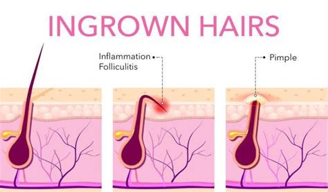 This can cause a painful pink or red bump to appear. What Causes Ingrown Leg Hairs and How to Prevent Them