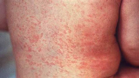 Rash And Swollen Lymph Nodes Causes Photos And Treatment