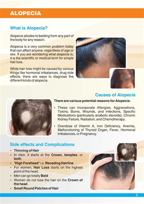 What Is Alopecia Hair Loss Typescausesdiagnosis And Treatment By