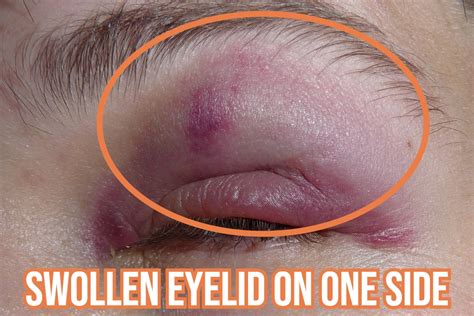 Unraveling Causes Why Is Only One Eyelid Swollen