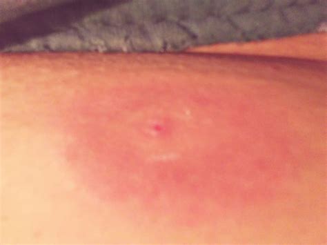 The pain associated with a brown recluse spider bite typically increases during the first eight hours after the bite. How to Identify and Treat Recluse (Fiddleback) Spider Bites