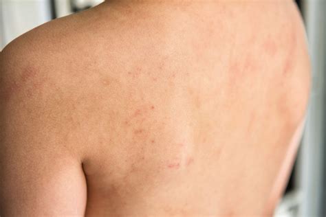 Is There A Connection Between Food Allergies And Eczema Nabta Health