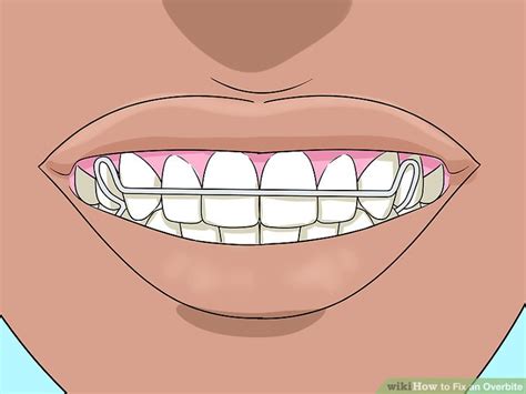 This is a thin strip of polyester film used to identify the presence or absence of occlusal or proximal contacts. How to Fix an Overbite: 9 Steps (with Pictures) - wikiHow