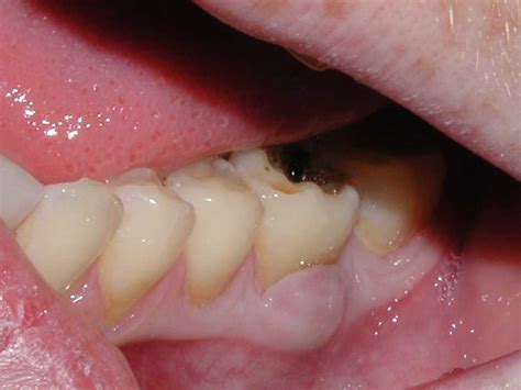 Badly Decayed Tooth 19 Extraction Dr Caputo Palm Harbor Dentist