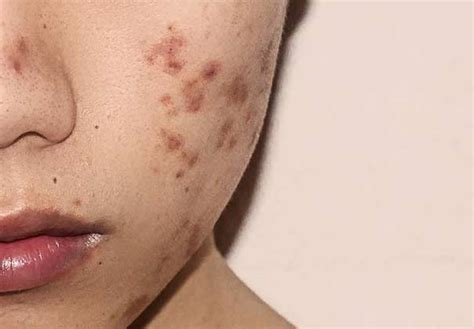 What Is Post Inflammatory Pigmentation Pih In Skincare