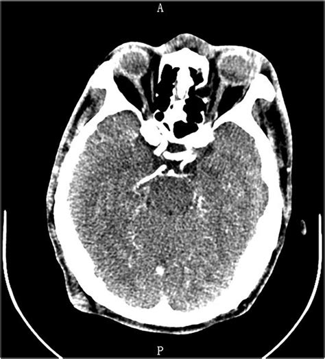 Enhanced Ct Shows The Lump On The Right Occipital Scalp Download
