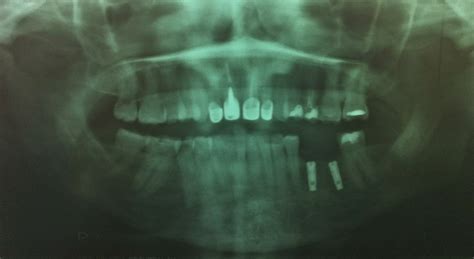 What Type Of X Rays Do I Need For A Dental Implant Dental Implant