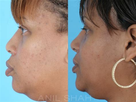 All said and done, the cost of a surgical is between $2,000 and $10,000, you can be given even a higher cost if you go to high profile rhinoplasty surgeons and the cost of a non surgical procedure is between $500 and $3500. Rhinoplasty Photos | Chicago IL | Patient 504