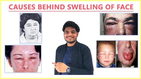 Swelling Face Causes Reasons For Swollen Face Puffiness Of Face