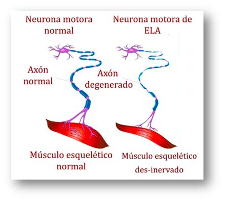 Se estima que más de la mitad de las motoneuronas se pierden antes de que comiencen a aparecer síntomas evidentes que pueden incluir. Esclerosis lateral amiotrófica. Conceptos básicos. - info-farmacia