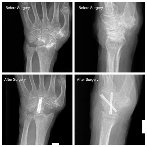 Slac Wrist Arthritis John Erickson Md
