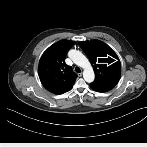 Axial View Of Pet Ct Scan Showing Moderate Fdg Uptake In The Lymph Node