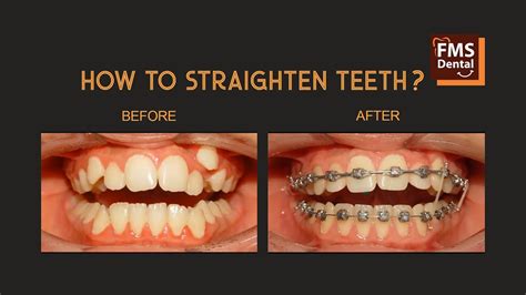 How To Straighten Teeth With Braces Best Age To Start Braces Fms Dental Hospitals Youtube