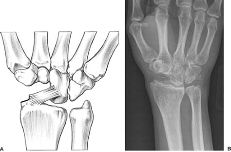 Insufficiency or iatrogenic damage could lead to ulnar translation and radiocapitate instability after surgery ( fig. Radial Styloidectomy | Musculoskeletal Key