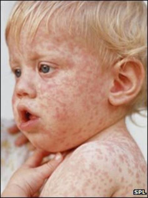 Who Issues Europe Measles Warning Bbc News