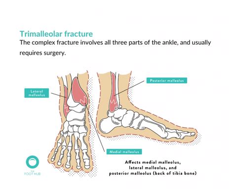Fractured Ankle How To Treat Them And How To Recover From Them The