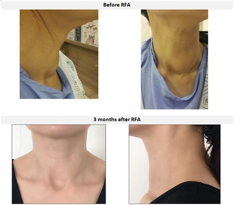 Radiofrequency Ablation Rfa Of Benign Thyroid Nodule