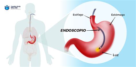 Doctor Camilo Ortiz Endoscopia De V As Digestivas Altas Bogot Colombia