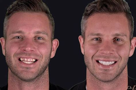 Mafs Jake Shows Off His Brand New Teeth After Major Transformation