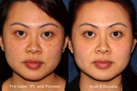Laser Ipl And Picoway Before And After For Brown Spots By Dr Wu Ipl