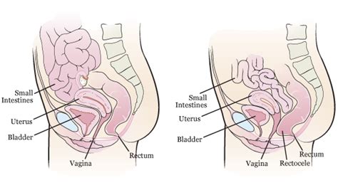 Rectocele Before And After